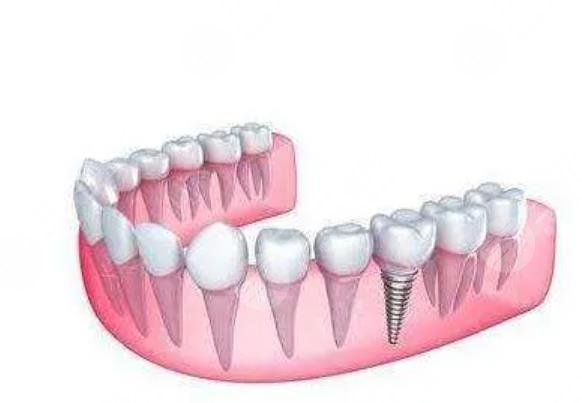 一般种植牙能用几年？种植牙之前如何选择医院？