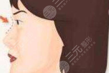 北京梅颜医美怎么样？医院综合口碑评价+隆鼻手术案例